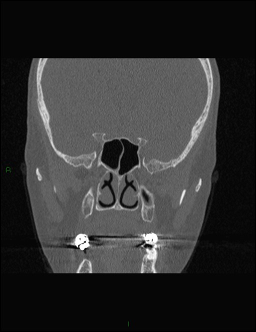 Bilateral frontal mucoceles (Radiopaedia 82352-96454 Coronal 197).jpg