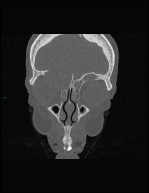 Bilateral frontal mucoceles (Radiopaedia 82352-96454 Coronal 92).jpg