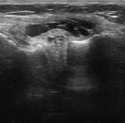 File:Bilateral lateral meniscal cysts (Radiopaedia 12200-12525 B 1).jpg