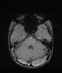 Bilateral mesial temporal polymicrogyria (Radiopaedia 76456-88181 Axial SWI 17).jpg