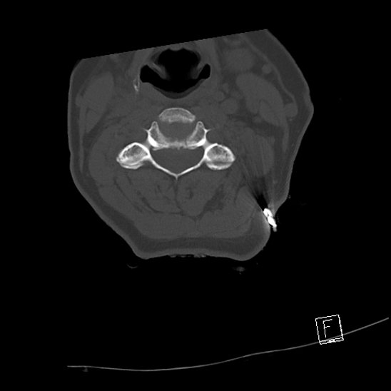 Bilateral occipital condyle fractures (type 3) (Radiopaedia 87672-104086 Axial bone window 38).jpg