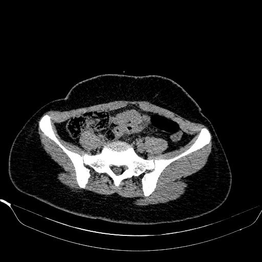 File:Bilateral ovarian dermoid (Radiopaedia 45714-49907 Axial non-contrast 8).JPEG