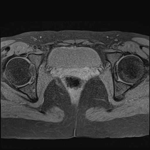 File:Bilateral ovarian endometriomas (Radiopaedia 87085-103347 Axial T1 fat sat 17).jpg