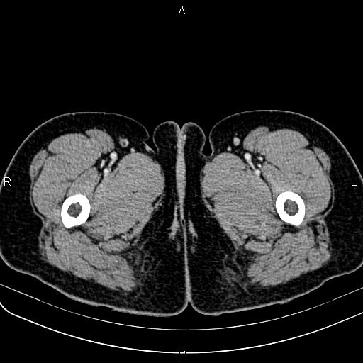 Bilateral ovarian teratoma (Radiopaedia 83131-97503 Axial With contrast 101).jpg