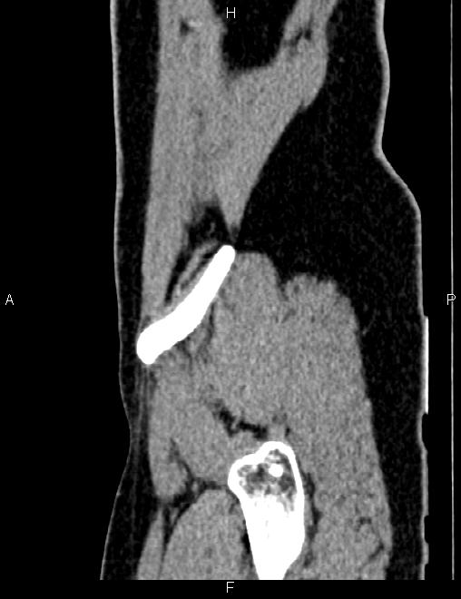 Bilateral ovarian teratoma (Radiopaedia 83131-97503 D 102).jpg