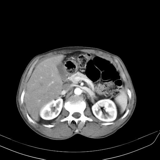 File:Bilateral parotid gland lymphoma (Radiopaedia 21038-20969 A 56).jpg