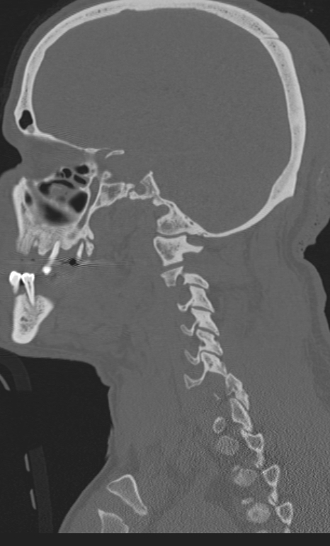 Bilateral perched facet joint (Radiopaedia 63149-71669 Sagittal bone window 2).jpg