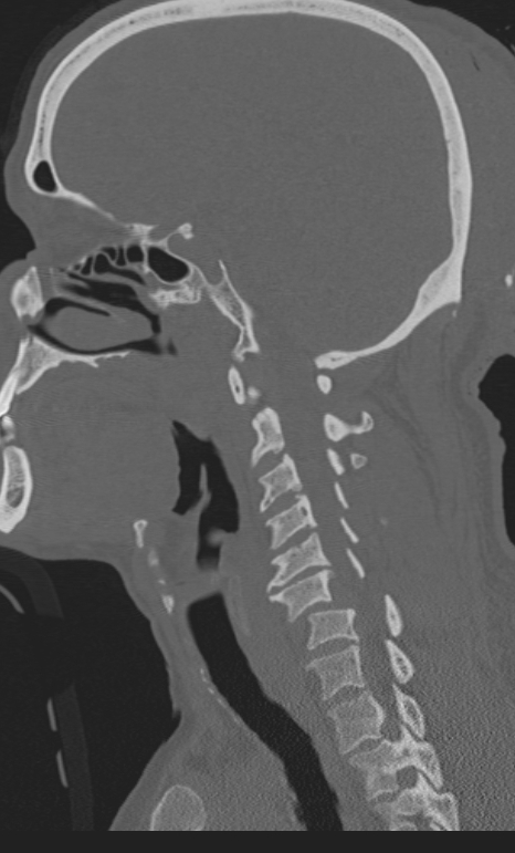 Bilateral perched facet joint (Radiopaedia 63149-71669 Sagittal bone window 40).jpg