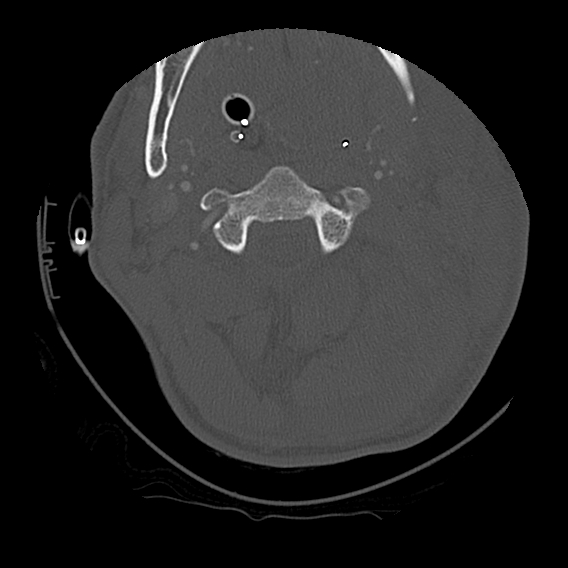 File:Bilateral perched facets with cord injury (Radiopaedia 45587-49713 Axial bone window 38).jpg