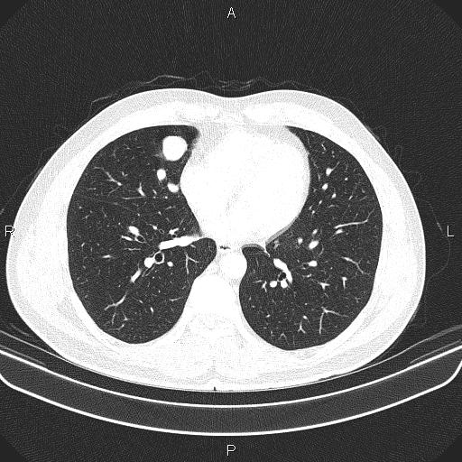 File:Bilateral pulmonary AVM (Radiopaedia 83134-97505 Axial lung window 47).jpg