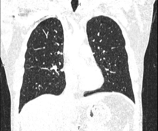 File:Bilateral pulmonary AVM (Radiopaedia 83134-97505 Coronal lung window 38).jpg