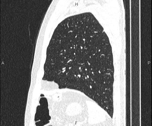 File:Bilateral pulmonary AVM (Radiopaedia 83134-97505 Sagittal lung window 88).jpg