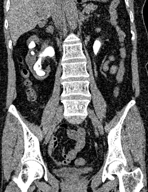 Bilateral staghorn calculi (Radiopaedia 59475-66842 Coronal non-contrast 62).jpg
