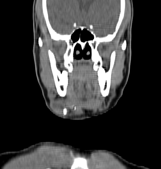 File:Bilateral submandibular sialolithiasis with sialadenitis (Radiopaedia 70721-80881 Coronal non-contrast 8).jpg