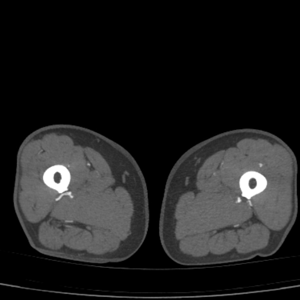 Bilateral superficial femoral arterial occlusion (Radiopaedia 25682-25857 A 41).jpg