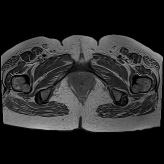 Bilateral tubo-ovarian abscesses (Radiopaedia 58635-65829 Axial T1 C+ 48).jpg