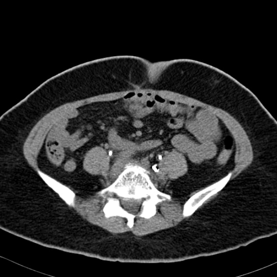 Bilateral ureteric stents (Radiopaedia 48795-53825 Axial non-contrast 40).jpg