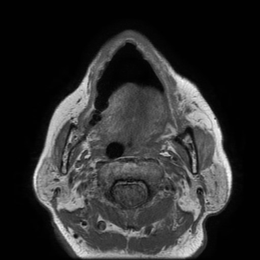 Bisphosphonate-related osteonecrosis of the maxilla (Radiopaedia 51367-57101 Axial T1 13).jpg