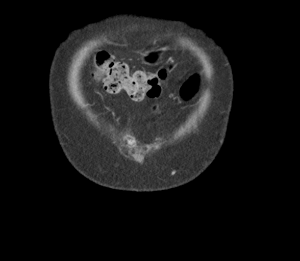 File:Bladder papillary urothelial carcinoma (Radiopaedia 48119-52951 C 6).png