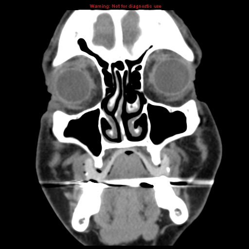 File:Blowout fracture with inferior rectus entrapment (Radiopaedia 12418-12673 Coronal non-contrast 4).jpg