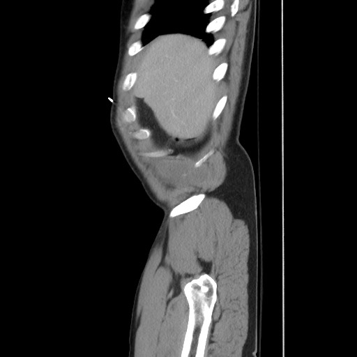 File:Blunt abdominal trauma with solid organ and musculoskelatal injury with active extravasation (Radiopaedia 68364-77895 C 27).jpg