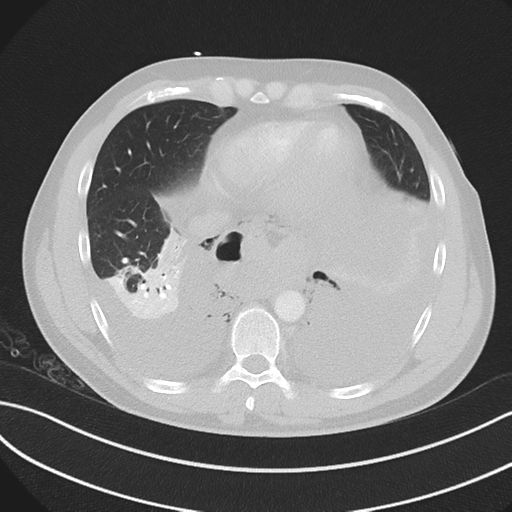 Boerhaave syndrome (Radiopaedia 39382-41660 Axial lung window 41).png