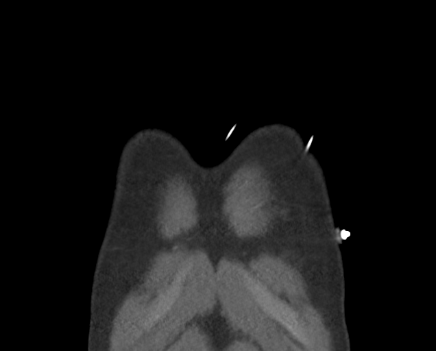 File:Boerhaave syndrome (Radiopaedia 39382-41660 C 7).png