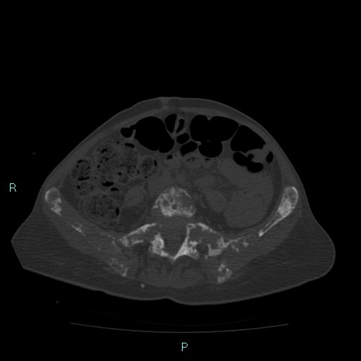 Bone metastases from untreated breast cancer (Radiopaedia 42973-46219 Axial bone window 141).jpg