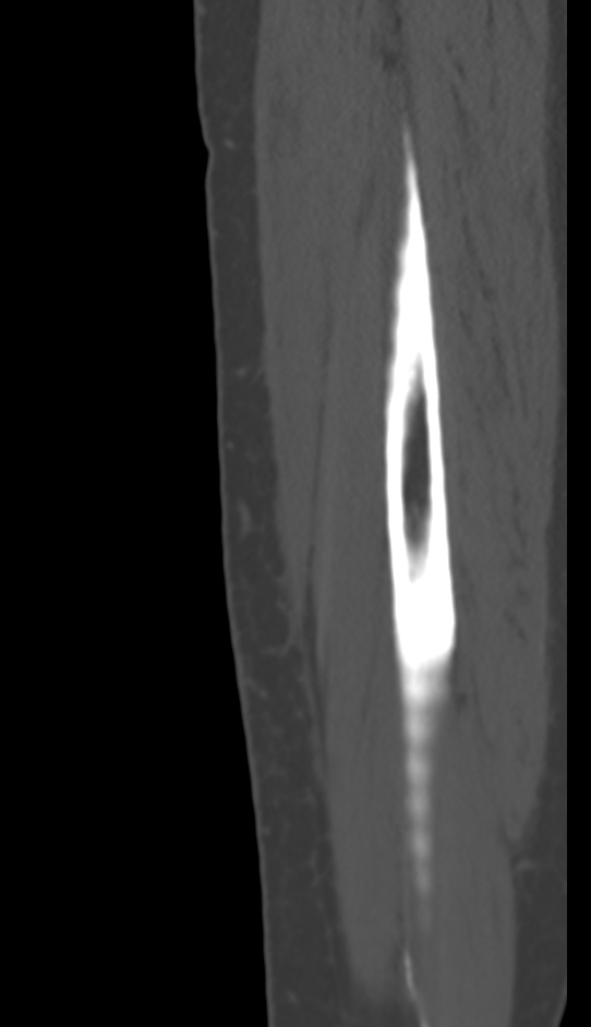 Bone metastasis - tibia (Radiopaedia 57665-64609 Sagittal bone window 170).jpg