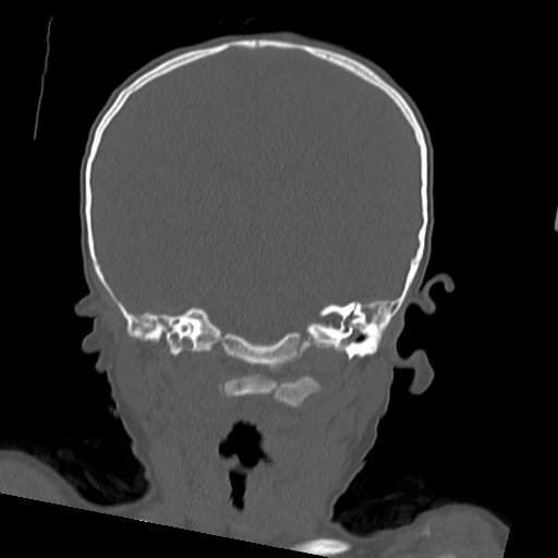 File:Bony atresia of the right external auditory canal (Radiopaedia 27916-28156 Coronal bone window 11).jpg