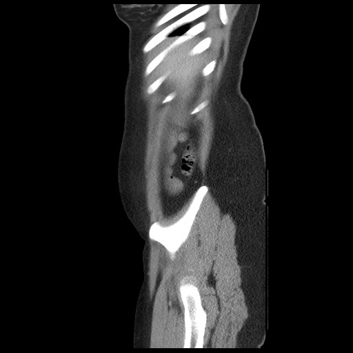 File:Borderline mucinous tumor (ovary) (Radiopaedia 78228-90808 B 13).jpg