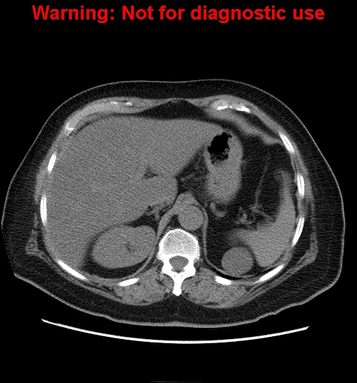 File:Bosniak renal cyst - type II (Radiopaedia 23404-23468 Axial non-contrast 2).jpg