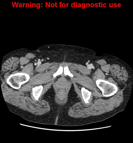 File:Bosniak renal cyst - type II (Radiopaedia 23404-23468 D 76).jpg