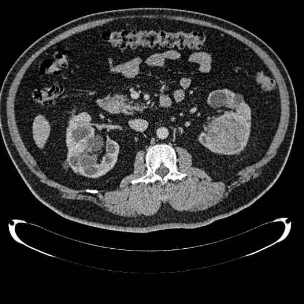 File:Bosniak renal cyst - type IV (Radiopaedia 24244-24518 C 154).jpg
