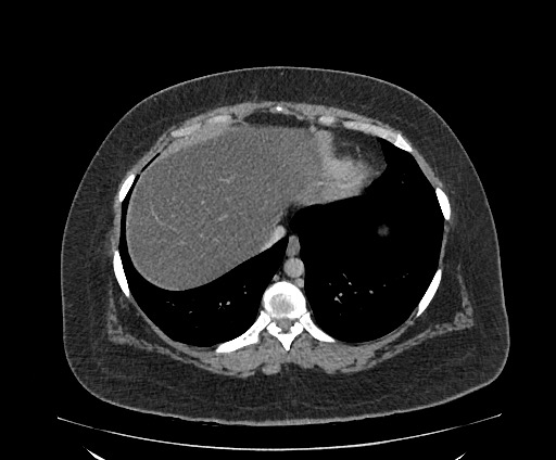 Bowel and splenic infarcts in acute lymphocytic leukemia (Radiopaedia 61055-68913 A 19).jpg