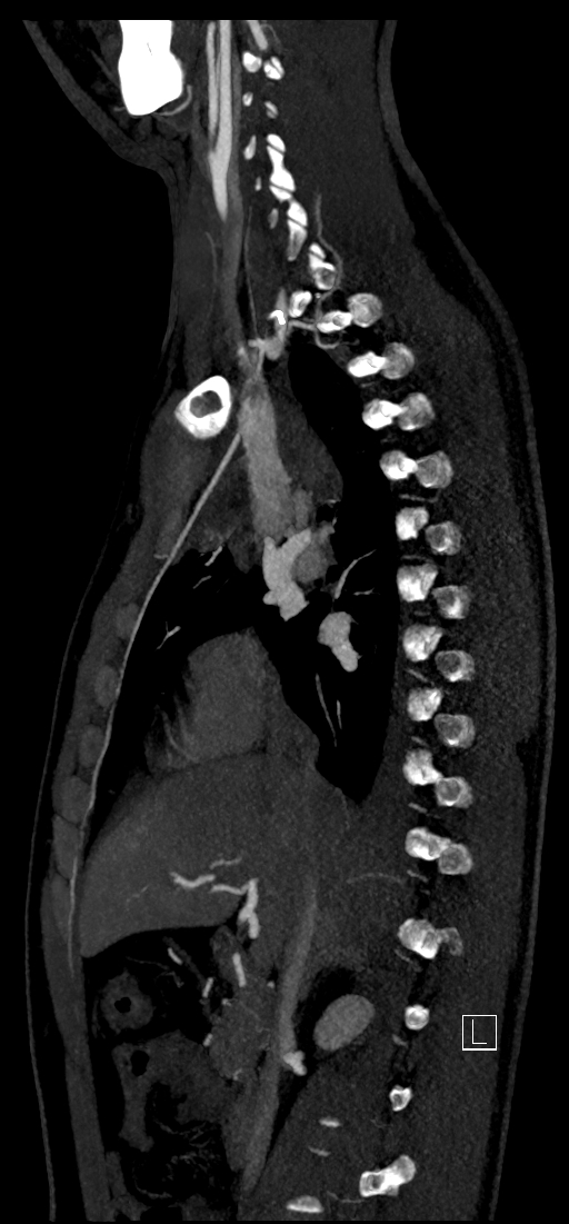 Brachiocephalic trunk pseudoaneurysm (Radiopaedia 70978-81191 C 39).jpg