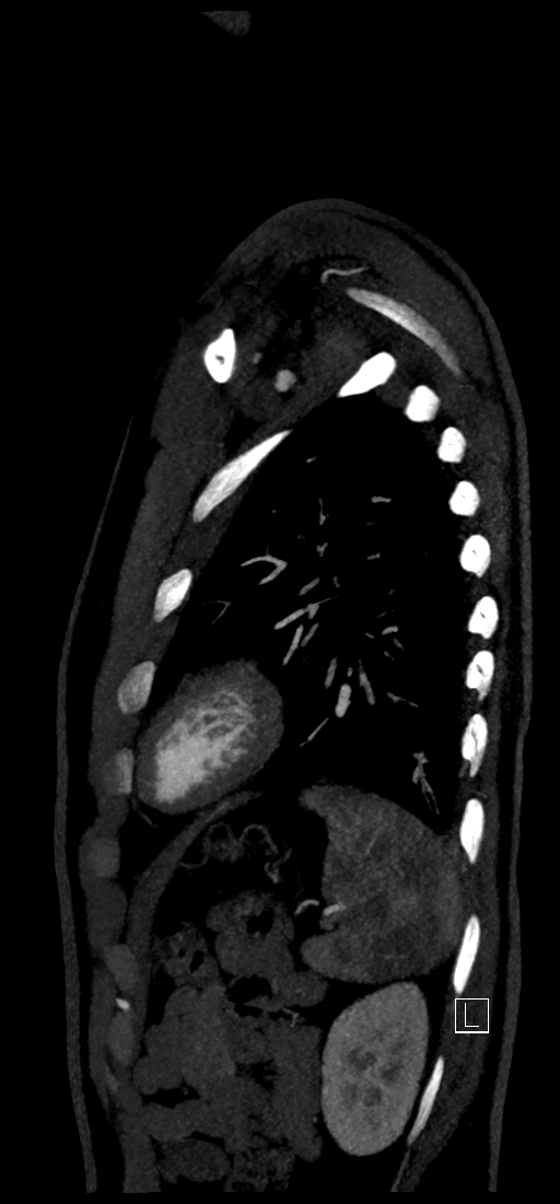 Brachiocephalic trunk pseudoaneurysm (Radiopaedia 70978-81191 C 75).jpg