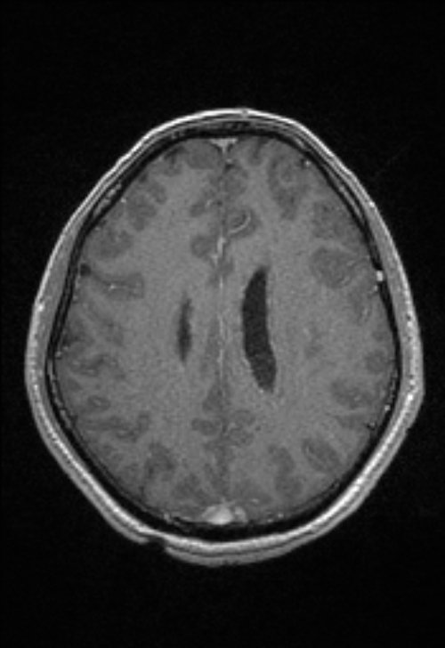 Brain abscess with ventriculitis (Radiopaedia 85703-101495 Axial T1 C+ 119).jpg