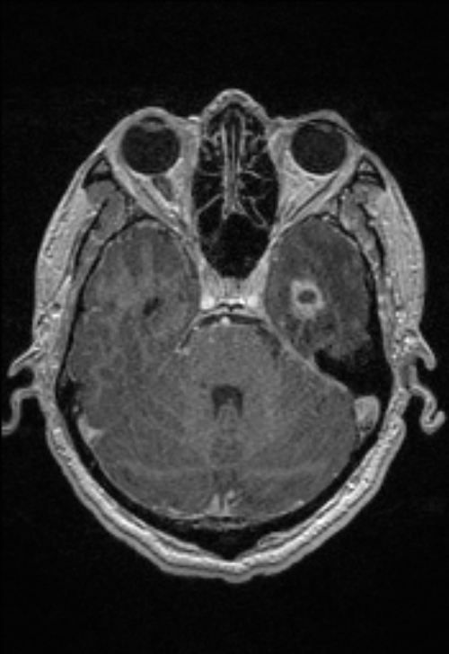 Brain abscess with ventriculitis (Radiopaedia 85703-101495 Axial T1 C+ 58).jpg