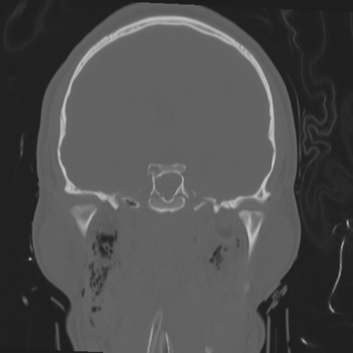 Brain contusions, internal carotid artery dissection and base of skull fracture (Radiopaedia 34089-35339 Coronal bone window 36).png