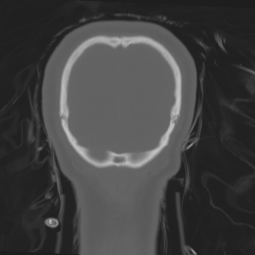 Brain contusions, internal carotid artery dissection and base of skull fracture (Radiopaedia 34089-35339 Coronal bone window 63).png