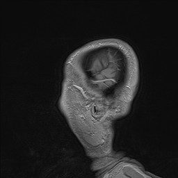 Brain metastasis (Radiopaedia 42617-45761 Sagittal T1 C+ 7).jpg