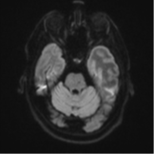 Brain metastasis (large cystic mass) (Radiopaedia 47497-52107 Axial DWI 36).png