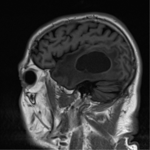 File:Brain metastasis (large cystic mass) (Radiopaedia 47497-52107 Sagittal T1 7).png