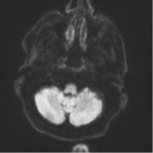 Brain metastasis (lung cancer) (Radiopaedia 48289-53179 Axial DWI 32).png