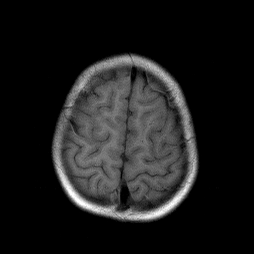 File:Brainstem ganglioglioma (Radiopaedia 10763-11224 Axial T1 3).jpg
