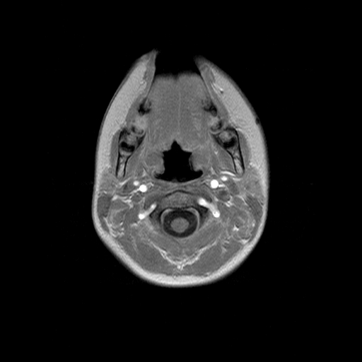 File:Brainstem ganglioglioma (Radiopaedia 10763-11224 Axial T1 C+ 19).jpg