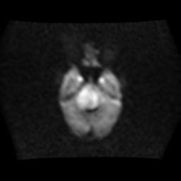 File:Brainstem glioma (Radiopaedia 30923-31624 Axial DWI 6).jpg
