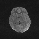 Brainstem glioma (Radiopaedia 67531-76922 Axial DWI 37).jpg