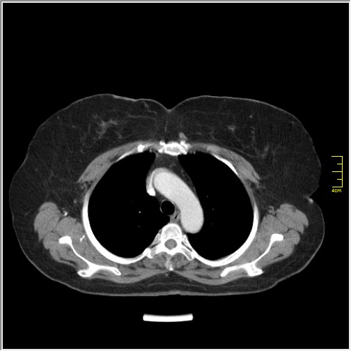 File:Breast cancer on thorax CT (Radiopaedia 60571-68275 A 28).JPG